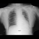 Deep sulcus, pneumothorax: X-ray - Plain radiograph